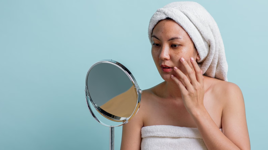 mulher-analisa-melasma-ao-redor-dos-olhos